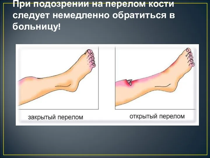 При подозрении на перелом кости следует немедленно обратиться в больницу!