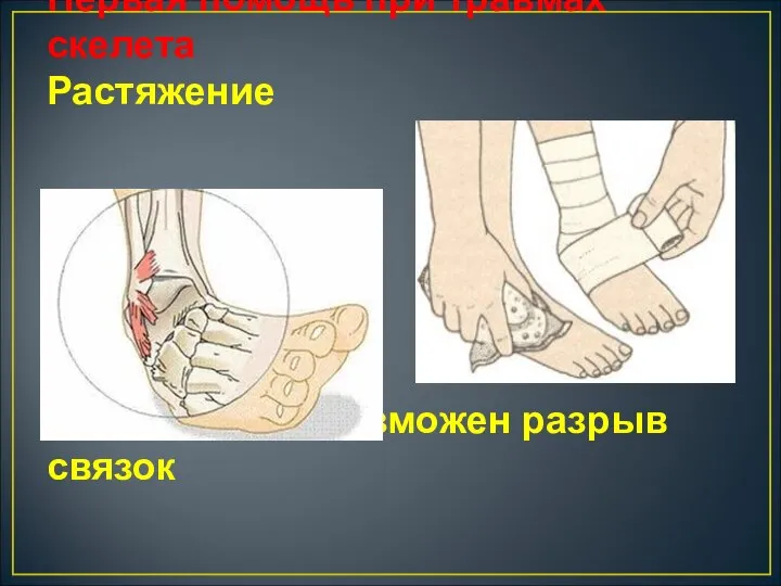 Первая помощь при травмах скелета Растяжение Последствия: возможен разрыв связок