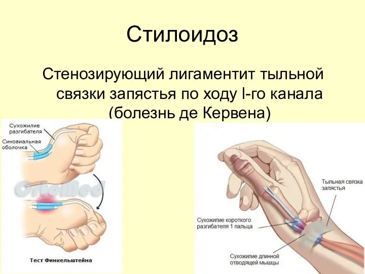 Стилоидоз Стенозирующий лигаментит тыльной связки запястья по ходу l-гo канала (болезнь де Кервена)