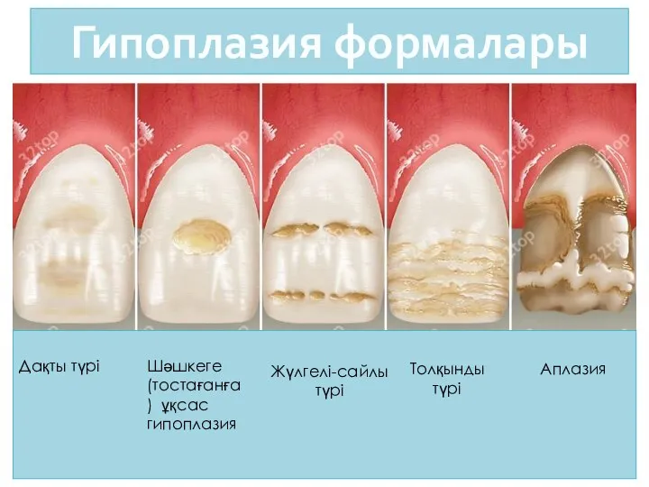 Дақты түрі Толқынды түрі Аплазия Жүлгелі-сайлы түрі Шәшкеге (тостағанға) ұқсас гипоплазия Гипоплазия формалары