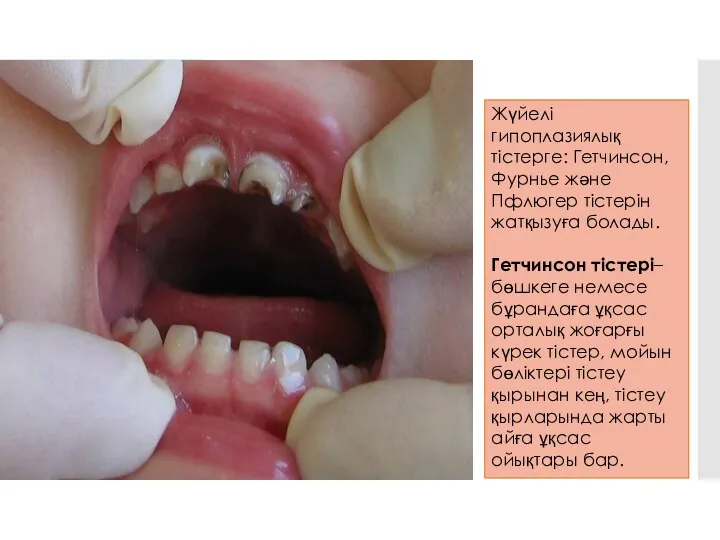 Жүйелі гипоплазиялық тістерге: Гетчинсон, Фурнье және Пфлюгер тістерін жатқызуға болады. Гетчинсон