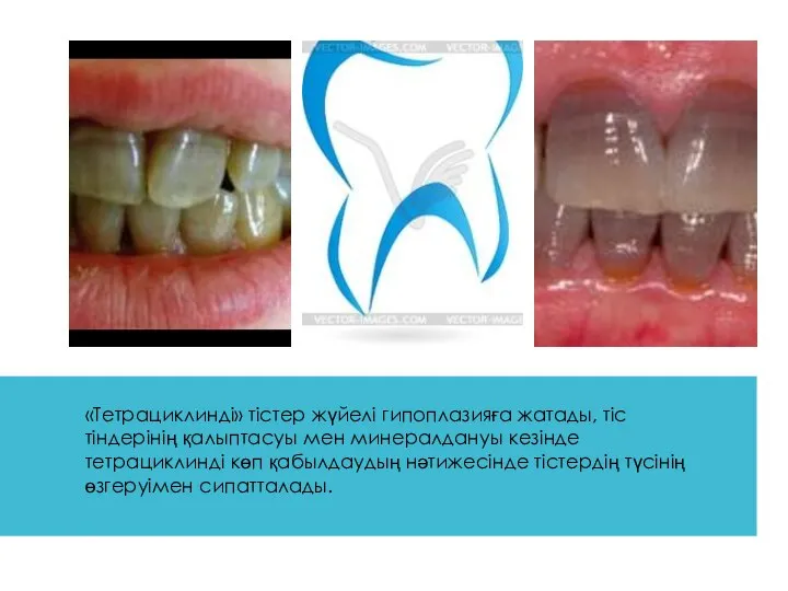 «Тетрациклинді» тістер жүйелі гипоплазияға жатады, тіс тіндерінің қалыптасуы мен минералдануы кезінде