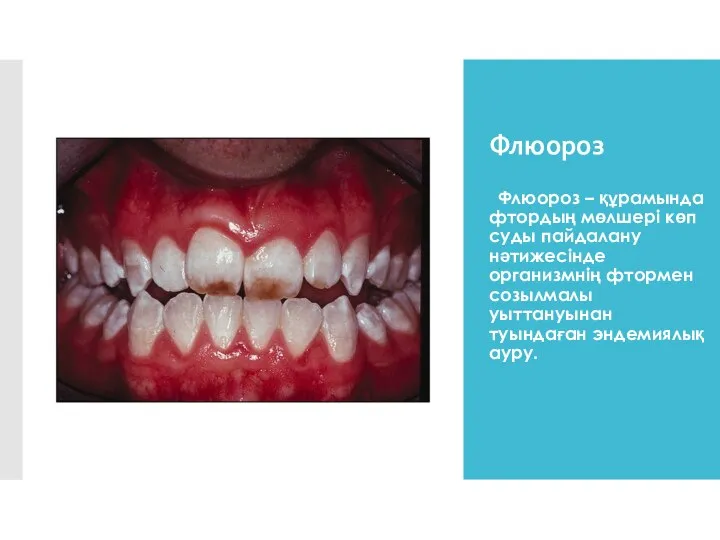 Флюороз Флюороз – құрамында фтордың мөлшері көп суды пайдалану нәтижесінде организмнің