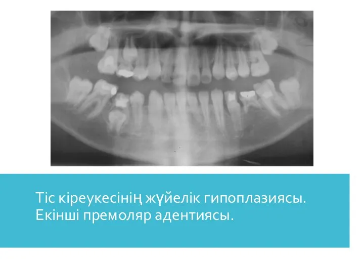 Тіс кіреукесінің жүйелік гипоплазиясы. Екінші премоляр адентиясы.