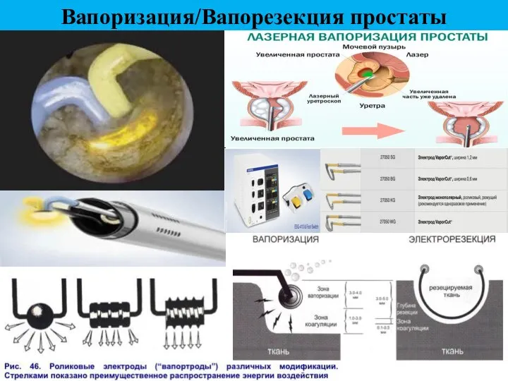 Вапоризация/Вапорезекция простаты