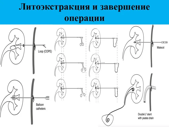 Литоэкстракция и завершение операции