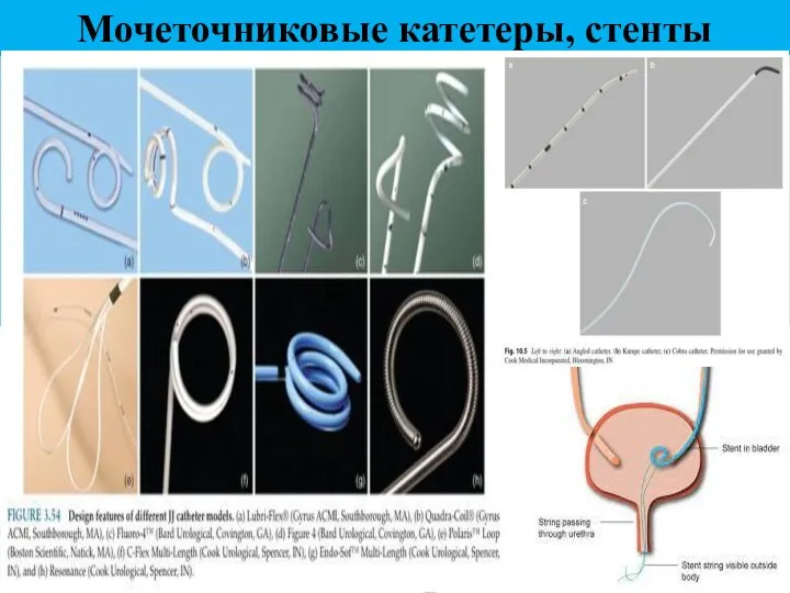 Мочеточниковые катетеры, стенты