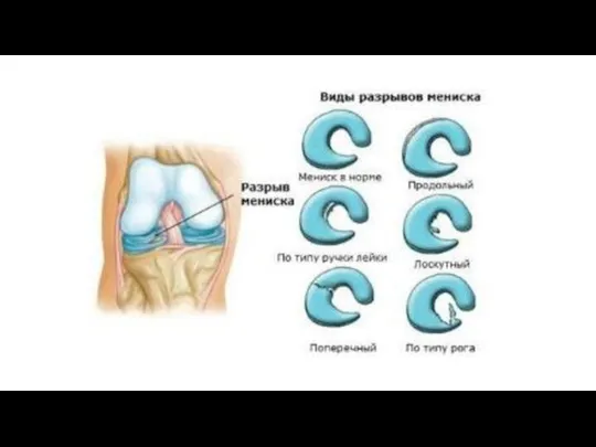 Симптомы разрыва мениска