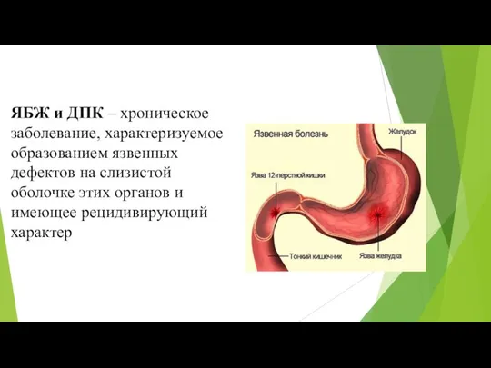 ЯБЖ и ДПК – хроническое заболевание, характеризуемое образованием язвенных дефектов на