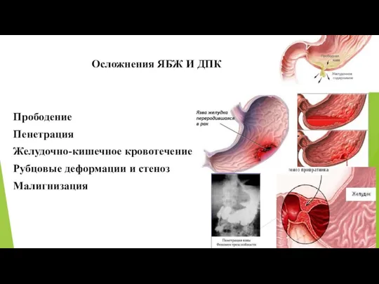 Осложнения ЯБЖ И ДПК Прободение Пенетрация Желудочно-кишечное кровотечение Рубцовые деформации и стеноз Малигнизация