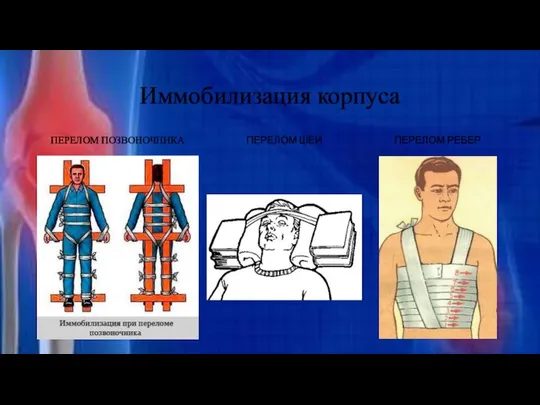 Иммобилизация корпуса ПЕРЕЛОМ ПОЗВОНОЧНИКА ПЕРЕЛОМ ШЕИ ПЕРЕЛОМ РЕБЕР