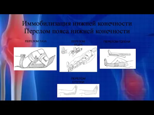 Иммобилизация нижней конечности Перелом пояса нижней конечности ПЕРЕЛОМ ТАЗА ПЕРЕЛОМ БЕДРА ПЕРЕЛОМ ГОЛЕНИ ПЕРЕЛОМ СТУПНИ