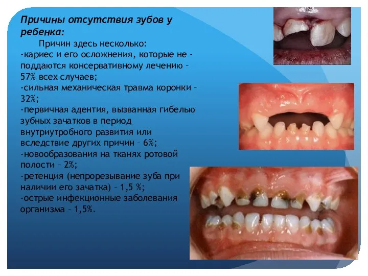 Причины отсутствия зубов у ребенка: Причин здесь несколько: -кариес и его