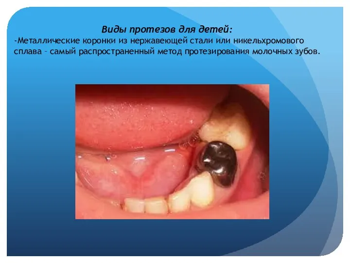 Виды протезов для детей: -Металлические коронки из нержавеющей стали или никельхромового