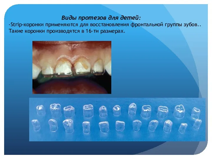 Виды протезов для детей: -Strip-коронки применяются для восстановления фронтальной группы зубов..