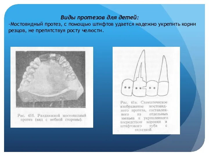 Виды протезов для детей: -Мостовидный протез, с помощью штифтов удается надежно