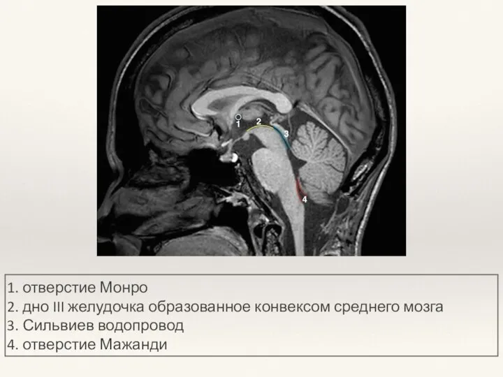 1. отверстие Монро 2. дно III желудочка образованное конвексом среднего мозга