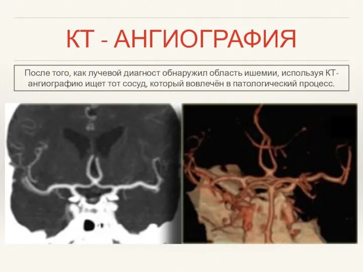 КТ - АНГИОГРАФИЯ После того, как лучевой диагност обнаружил область ишемии,