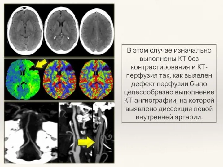 В этом случае изначально выполнены КТ без контрастирования и КТ-перфузия так,