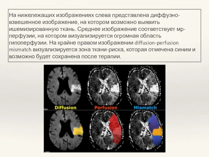 На нижележащих изображениях слева представлена диффузно-взвешенное изображение, на котором возможно выявить