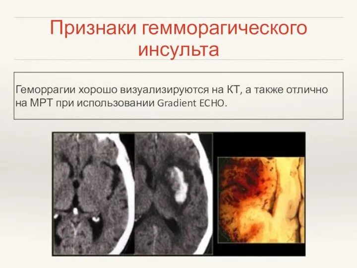 Признаки гемморагического инсульта Геморрагии хорошо визуализируются на КТ, а также отлично