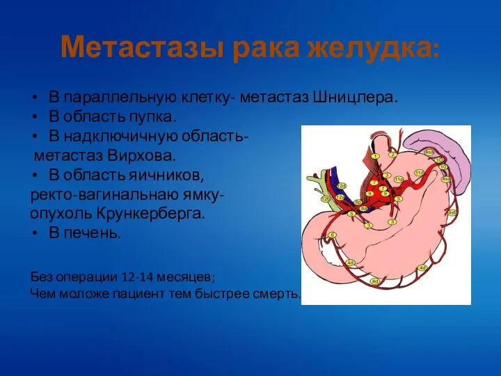 Метастазы рака желудка: В параллельную клетку- метастаз Шницлера. В область пупка.