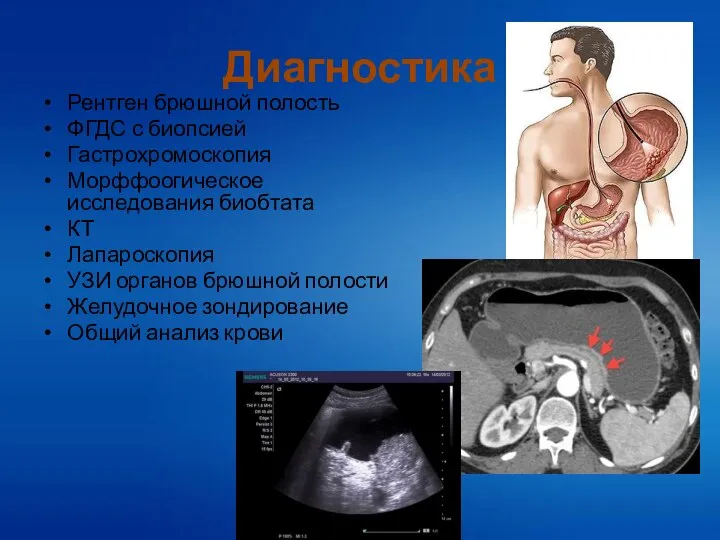 Диагностика Рентген брюшной полость ФГДС с биопсией Гастрохромоскопия Морффоогическое исследования биобтата