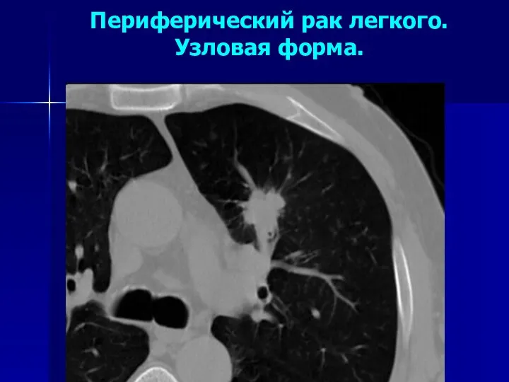 Периферический рак легкого. Узловая форма.