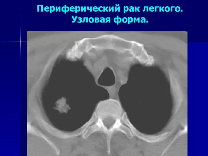 Периферический рак легкого. Узловая форма.