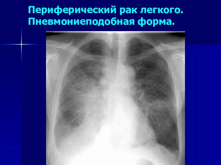 Периферический рак легкого. Пневмониеподобная форма.