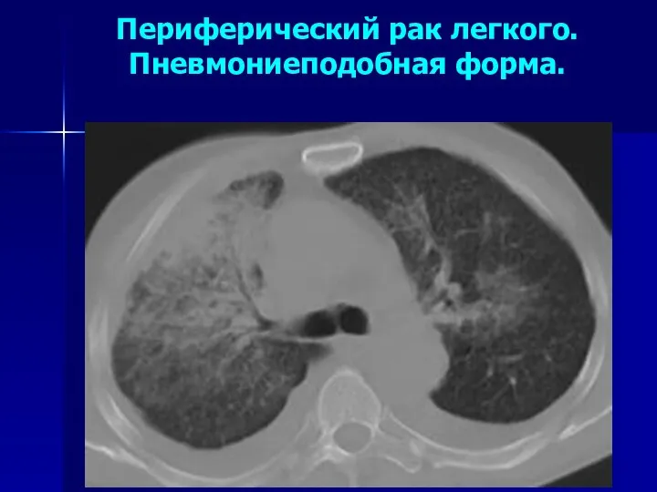 Периферический рак легкого. Пневмониеподобная форма.