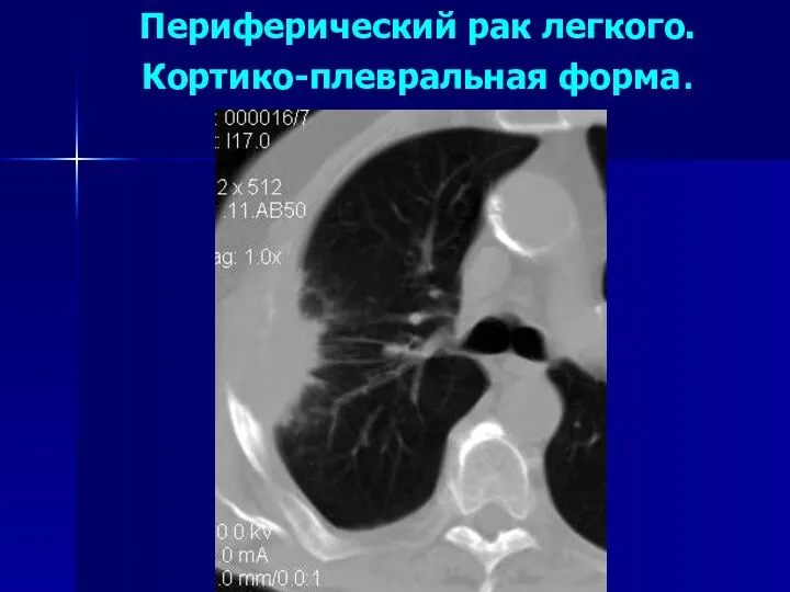 Периферический рак легкого. Кортико-плевральная форма.