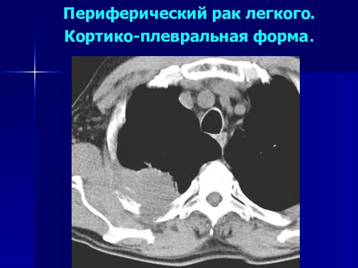 Периферический рак легкого. Кортико-плевральная форма.