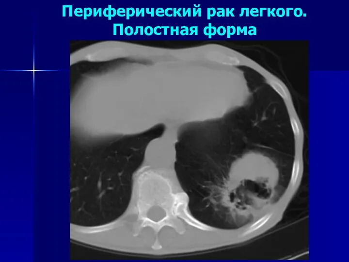 Периферический рак легкого. Полостная форма