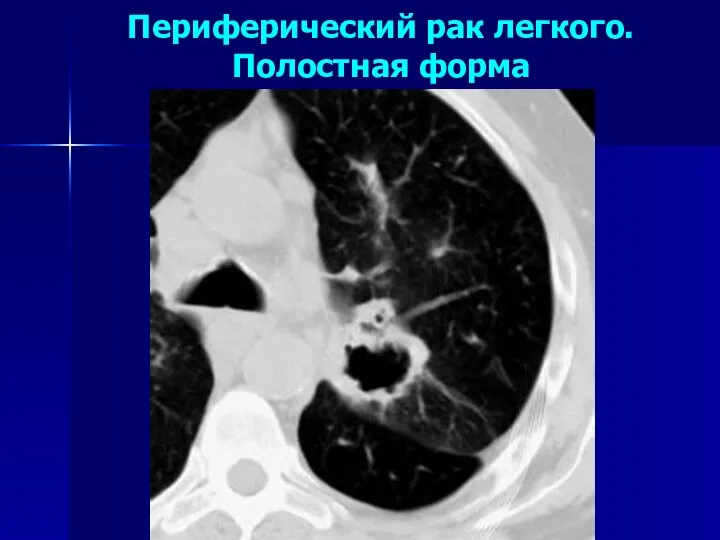 Периферический рак легкого. Полостная форма