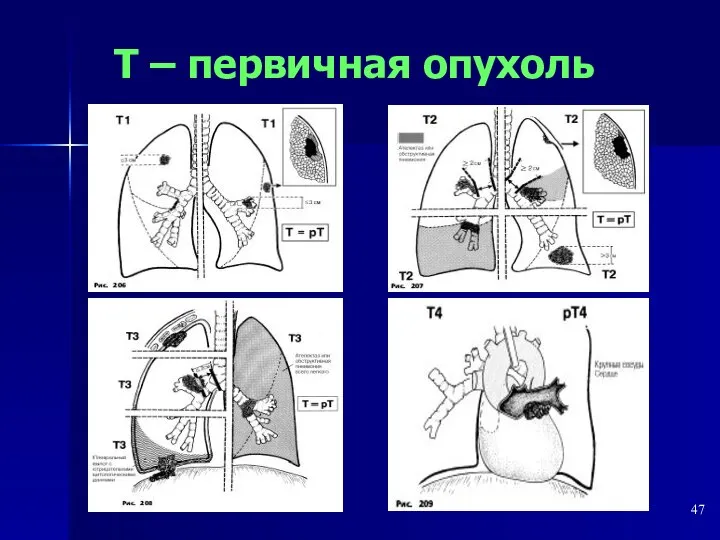 Т – первичная опухоль