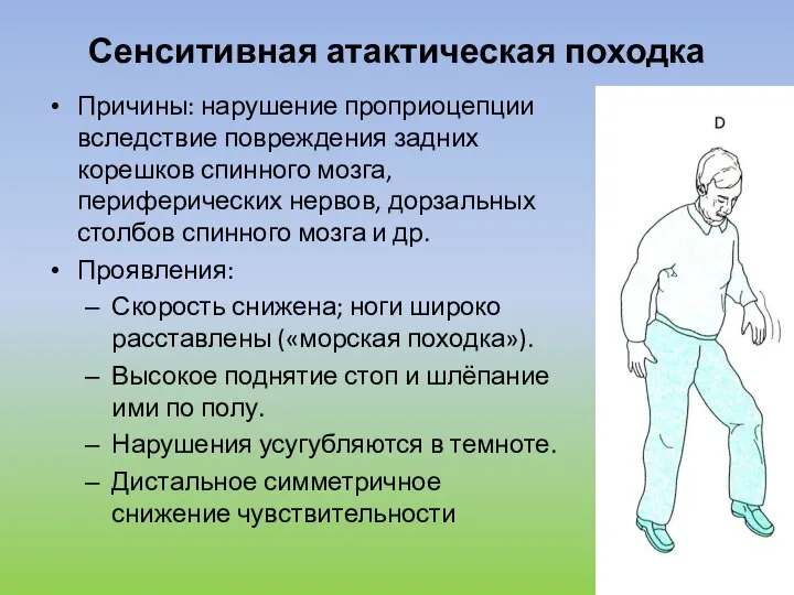 Сенситивная атактическая походка Причины: нарушение проприоцепции вследствие повреждения задних корешков спинного