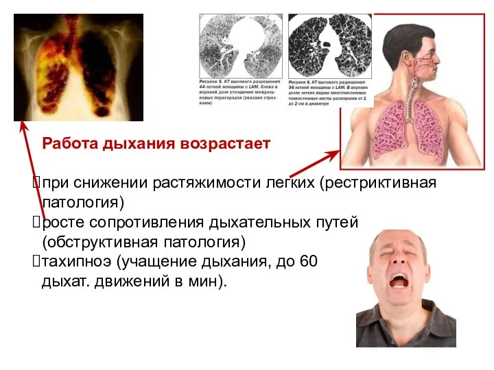 Работа дыхания возрастает при снижении растяжимости легких (рестриктивная патология) росте сопротивления