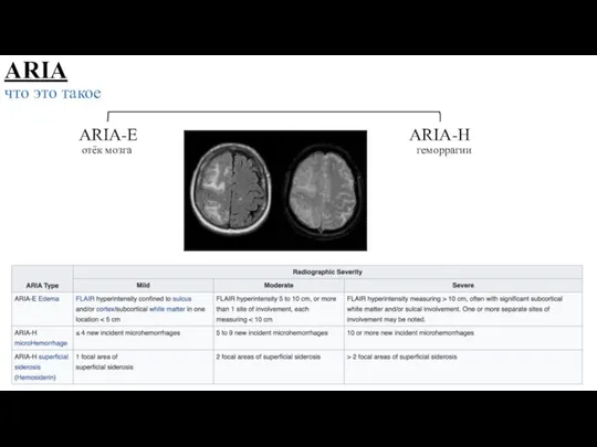 ARIA что это такое ARIA-E ARIA-H отёк мозга геморрагии