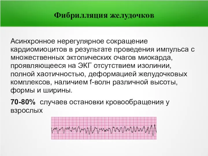 Фибрилляция желудочков Асинхронное нерегулярное сокращение кардиомиоцитов в результате проведения импульса с