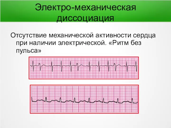 Электро-механическая диссоциация Отсутствие механической активности сердца при наличии электрической. «Ритм без пульса»