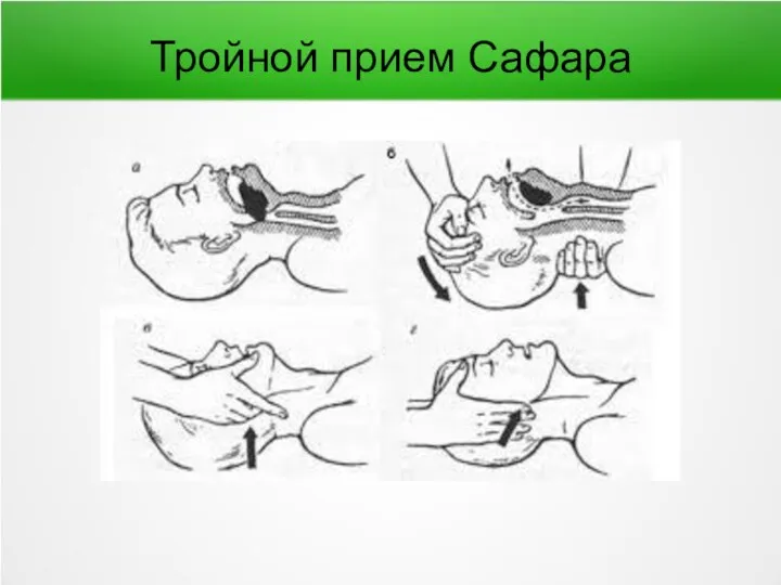 Тройной прием Сафара