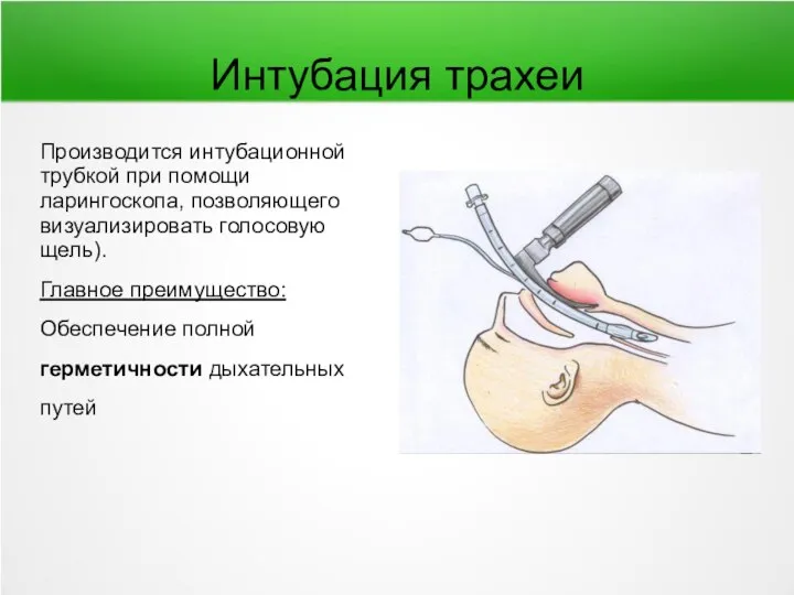 Интубация трахеи Производится интубационной трубкой при помощи ларингоскопа, позволяющего визуализировать голосовую