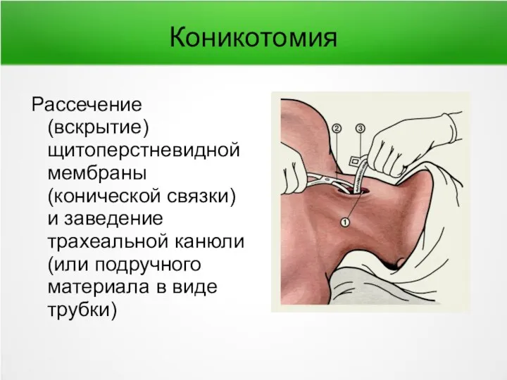 Коникотомия Рассечение (вскрытие) щитоперстневидной мембраны (конической связки) и заведение трахеальной канюли