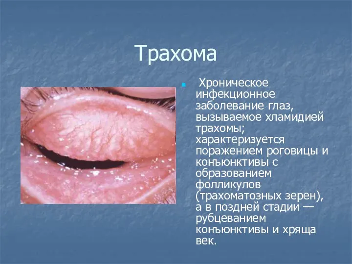 Трахома Хроническое инфекционное заболевание глаз, вызываемое хламидией трахомы; характеризуется поражением роговицы