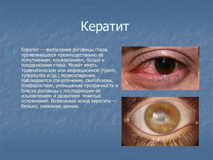 Кератит Кератит — воспаление роговицы глаза, проявляющееся преимущественно её помутнением, изъязвлением,