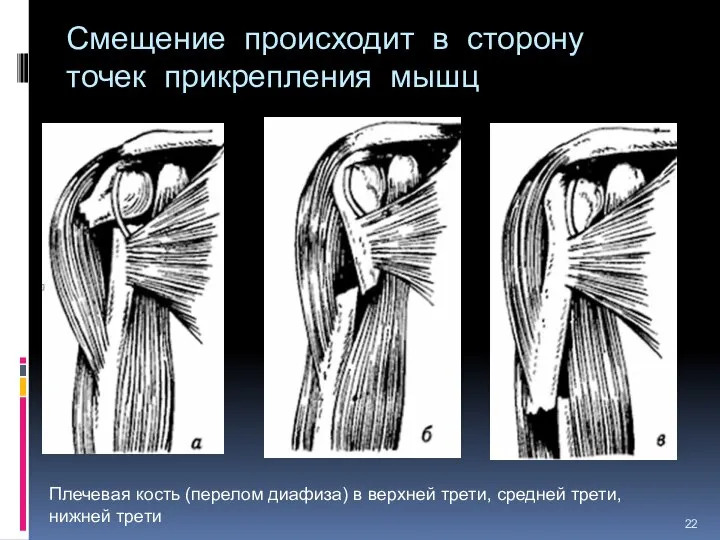 Смещение происходит в сторону точек прикрепления мышц Плечевая кость (перелом диафиза)