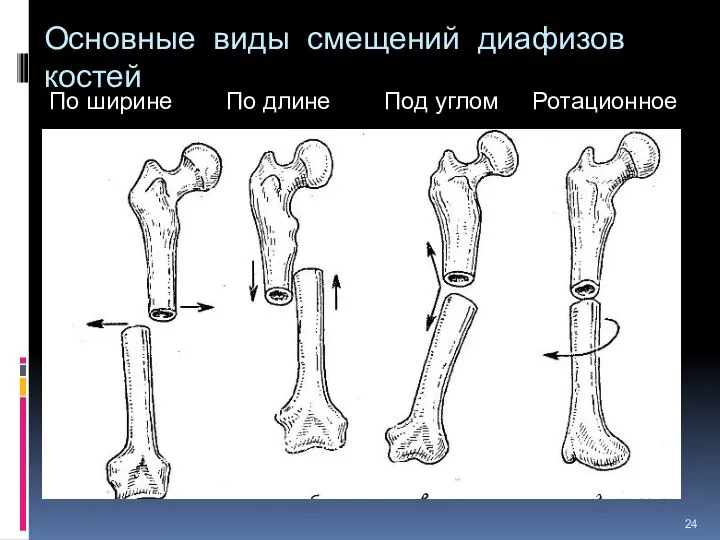 Основные виды смещений диафизов костей По ширине По длине Под углом Ротационное