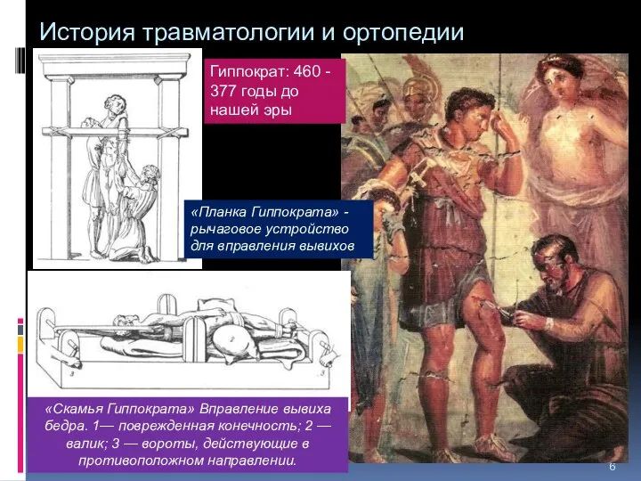 История травматологии и ортопедии «Планка Гиппократа» - рычаговое устройство для вправления