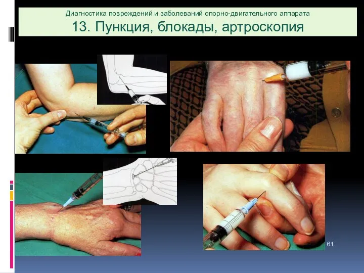 Диагностика повреждений и заболеваний опорно-двигательного аппарата 13. Пункция, блокады, артроскопия